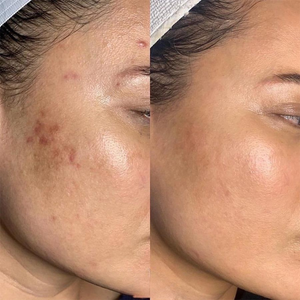 Sérum éclat pour éliminer les taches brunes